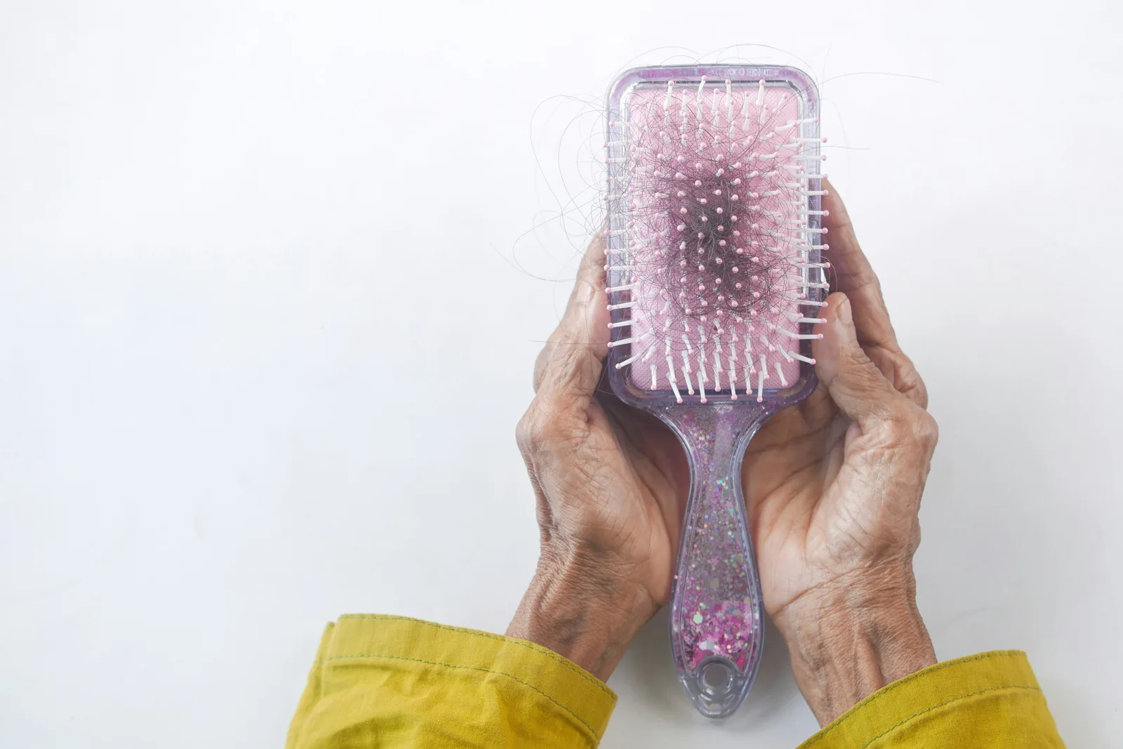 Caspa faz o cabelo cair - queda de cabelo relacionada à caspa