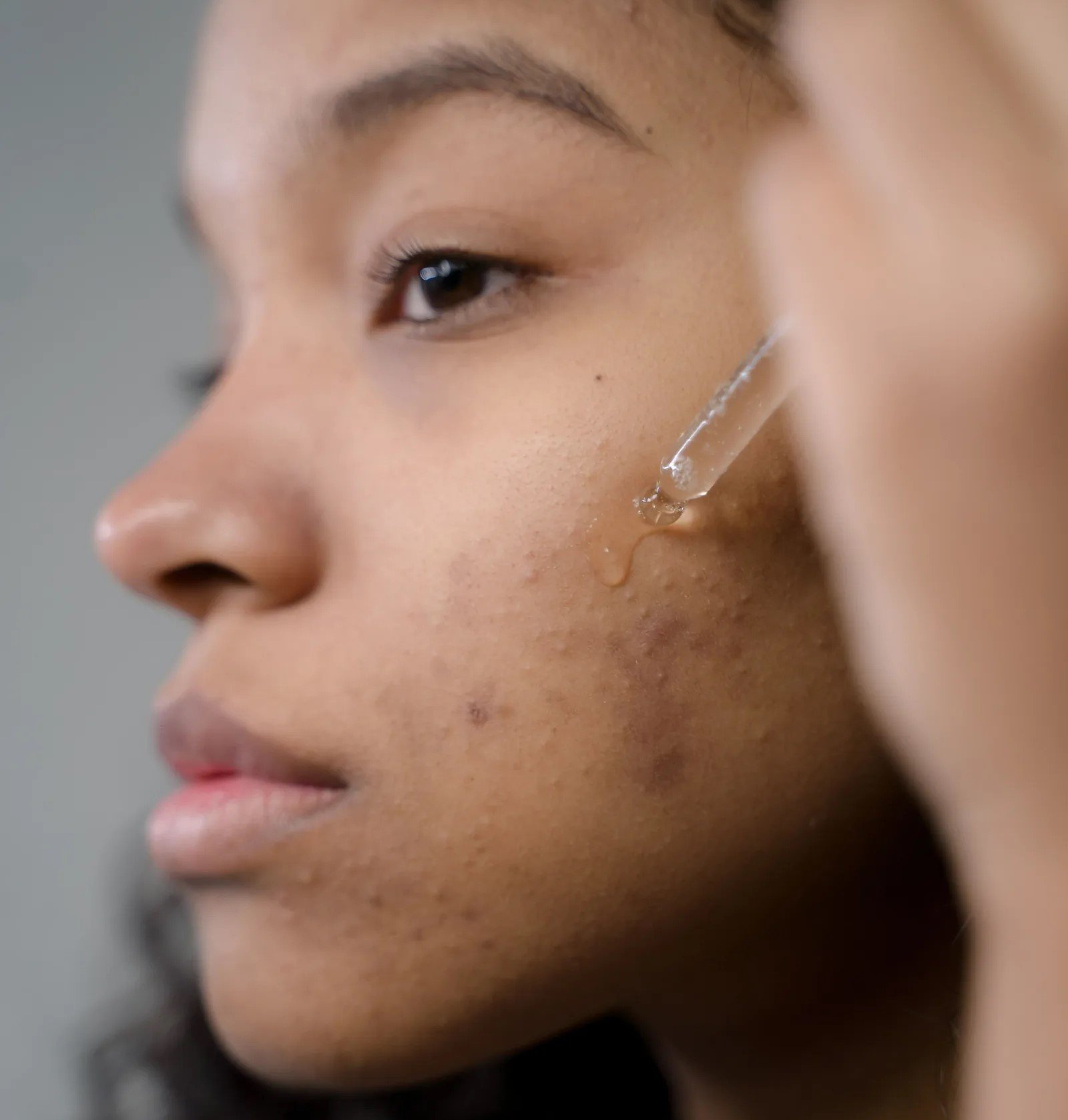 Como acabar com a acne
