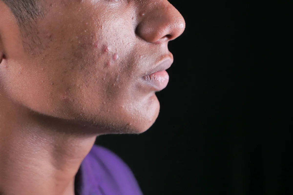 close-up de lesões de acne no rosto