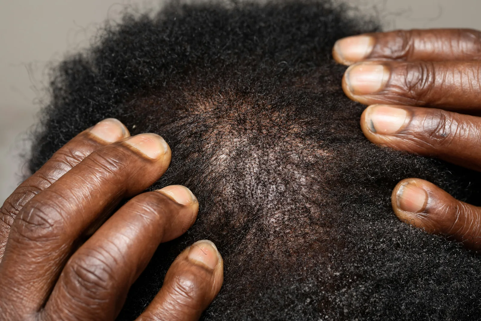 Dermatite seborreica no couro cabeludo - sintomas e diferença da caspa comum